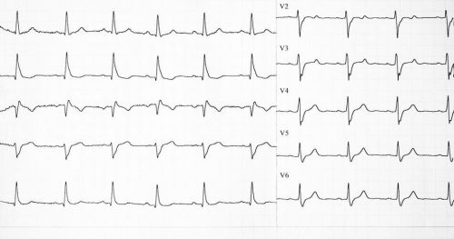 Tachykardia zatokowa – czy częstoskurcz serca jest groźny dla zdrowia?