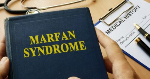 Syndrom Marfana – codzienność z chorobą. Jak objawia się zespół Marfana i czy można go leczyć?