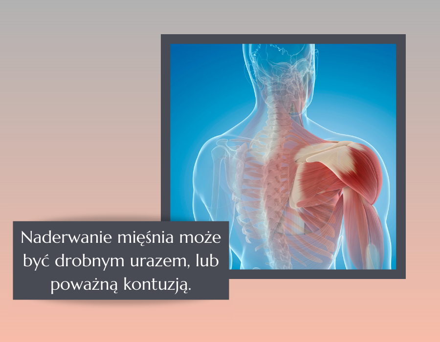 naderwanie mięśnia może być drobnym urazem, lub poważną kontuzją